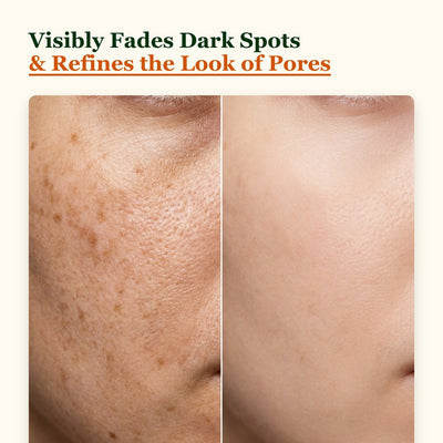 Choglow dark spot oil before and after fading dark spots in 4 weeks